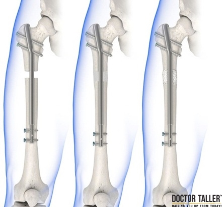 Phẫu thuật kéo dài chân dựa trên cơ chế tái tạo các xương mới